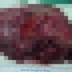 Şanlıurfa’da karın boşluğundan 25 santimlik dev kist çıktı