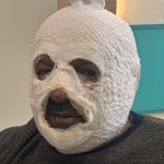 Erzincan’da kalorifer yakmak isterken kendini yaktı