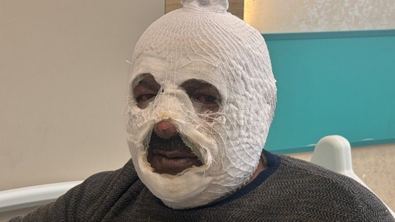 Erzincan’da kalorifer yakmak isterken kendini yaktı