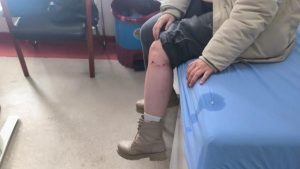 Kayseri’de sokak köpeğinin saldırdığı çocuk yaralandı