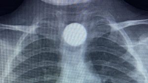 Bursa’da 3 yaşındaki Bilal’in yuttuğu madeni para, yemek borusunda kaldı