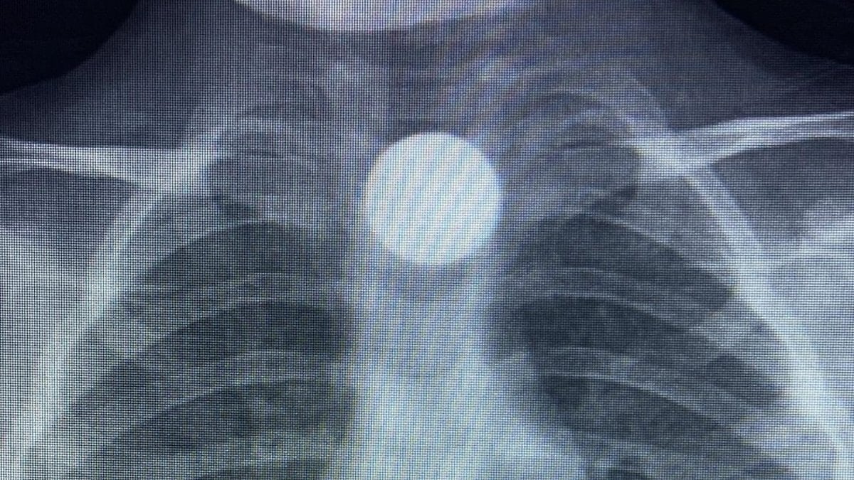 Bursa’da 3 yaşındaki Bilal’in yuttuğu madeni para, yemek borusunda kaldı