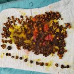 Manisa’da karın ağrısı şikayetiyle hastaneye giden kadının safra kesesinden binlerce taş çıktı