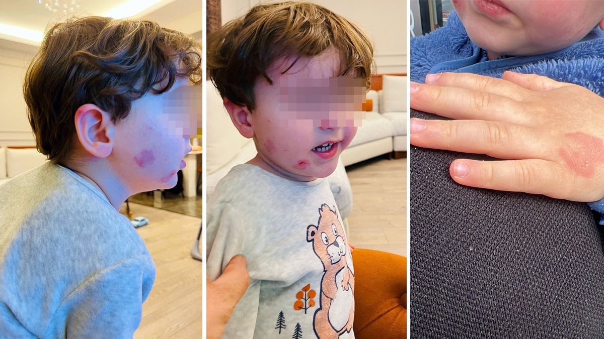 Bursa’da kreşe sağlam giren çocuk, akşam darbedilmiş halde çıktı